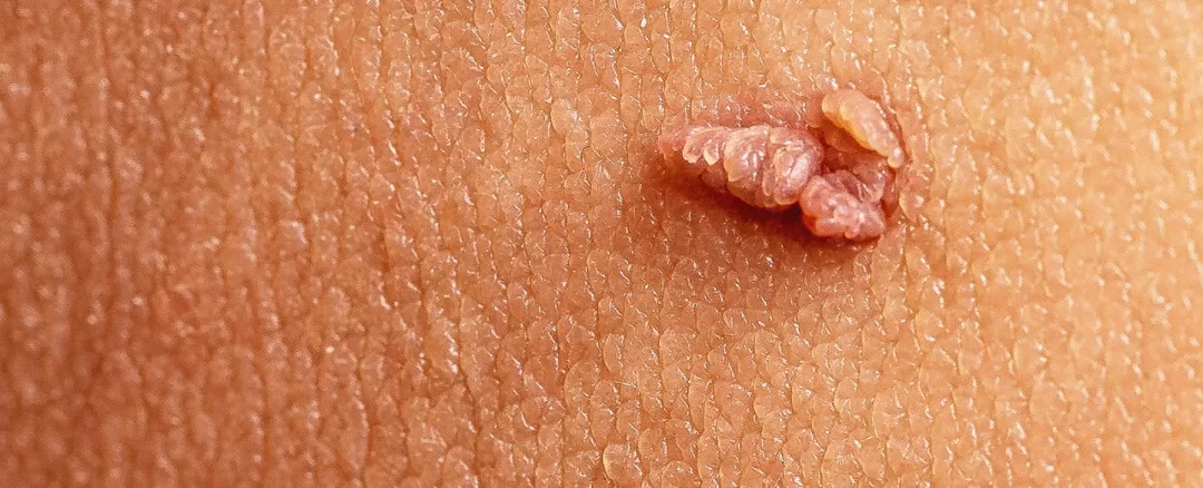 ¿Sabías que el condón no puede protegerte completamente del VPH?