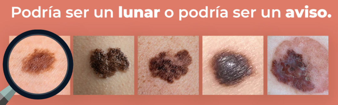 El método ABCDE: Aprende a identificar señales tempranas de cáncer de piel